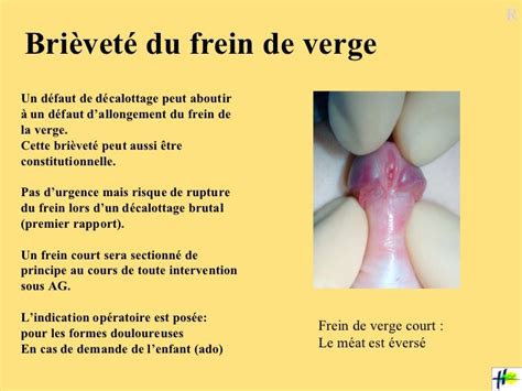 rupture du frein du prepuce|Rupture du frein du prépuce : risques et traitements